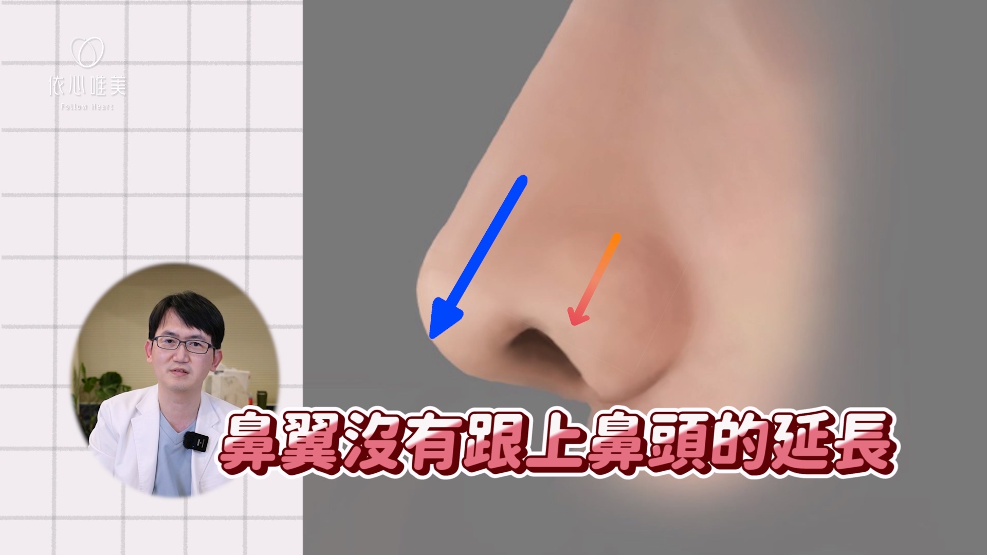 當鼻翼沒有跟上鼻頭的延長，反而還是會露鼻孔