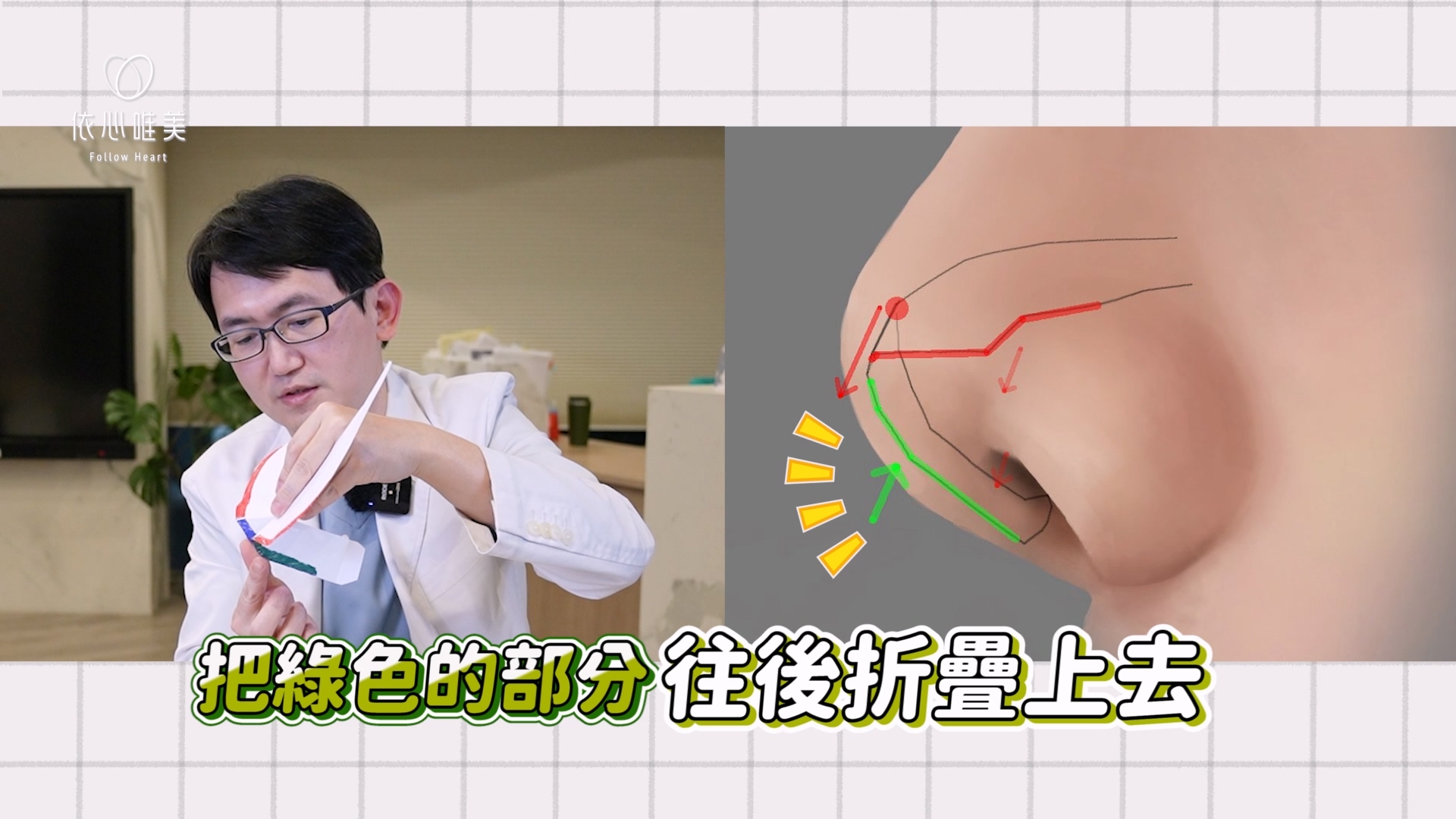 當紅色部分的鼻頭延長，雖然可以改善露鼻孔，但會讓鼻頭變尖，此時就需要將綠色部分的鼻頭軟骨往後折疊上去，改善鼻頭