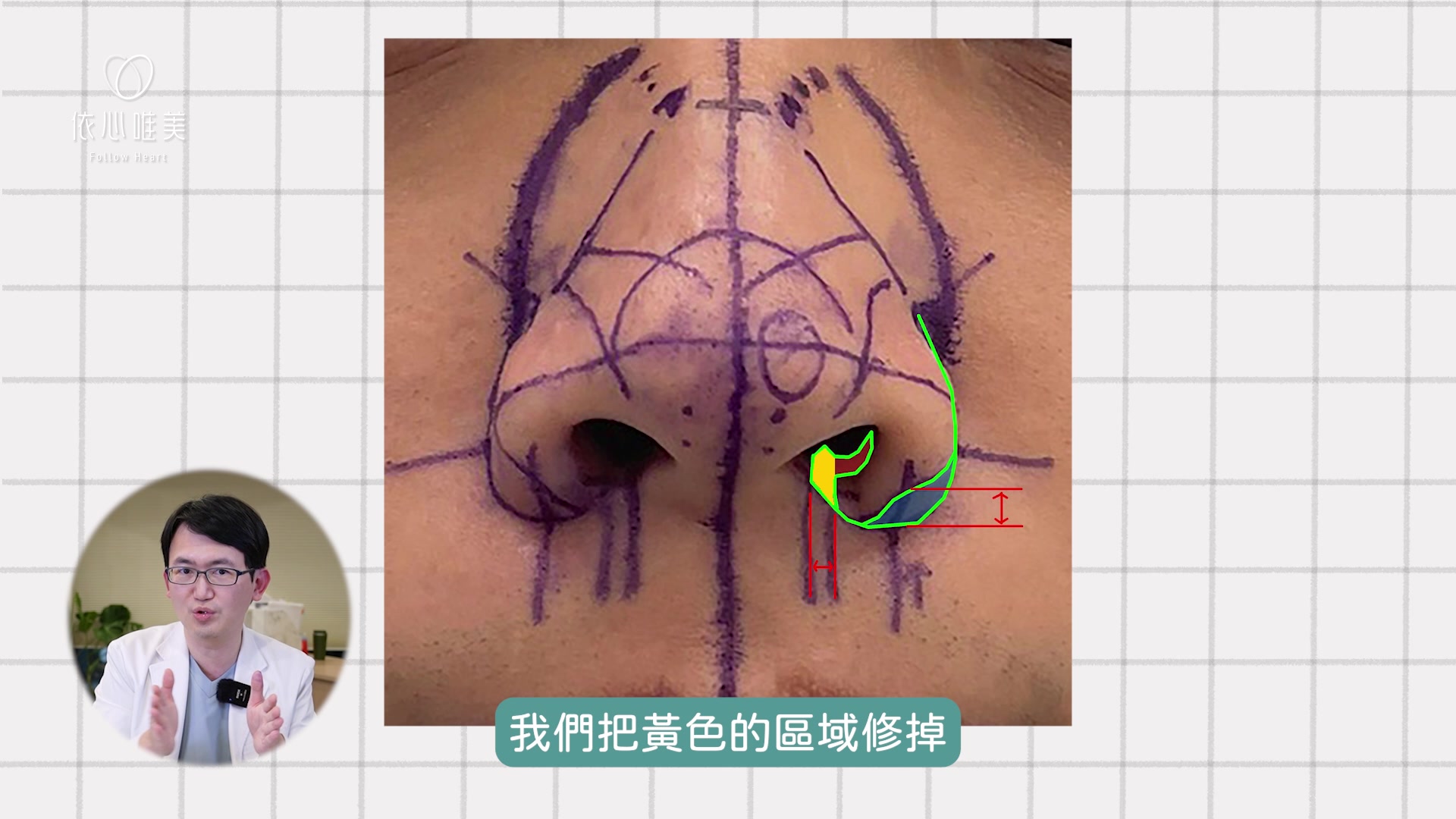 內縮鼻翼:修除黃色區域，將鼻孔地板變窄