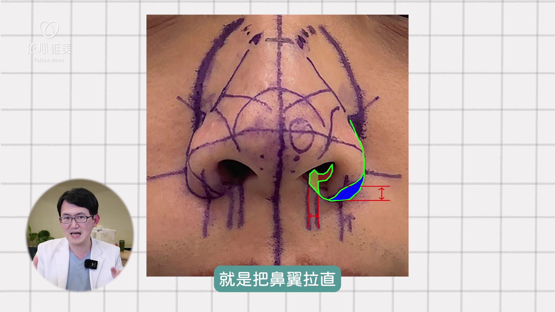 外縮鼻翼:修除藍色區域，將鼻翼拉直