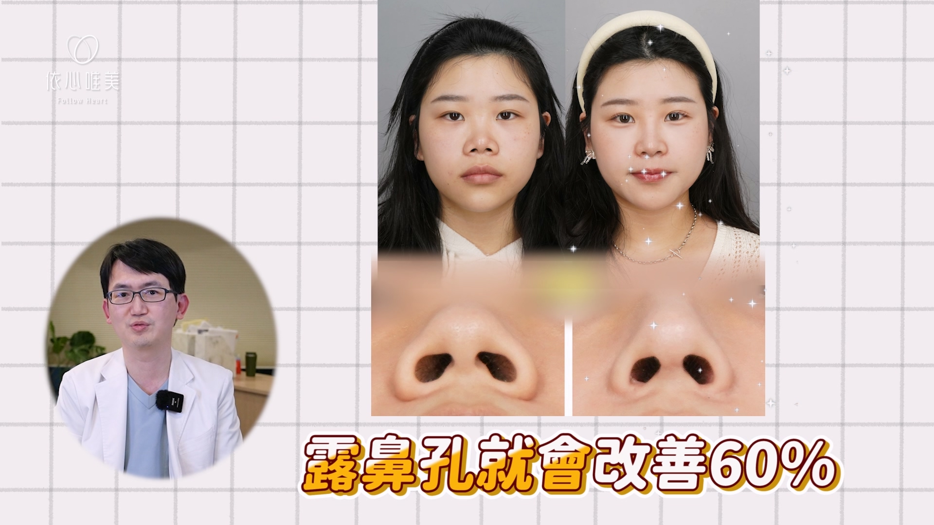 隆鼻+鼻頭軟骨折疊，內外上縮鼻翼，兩種方法合併，露鼻孔約改善六成