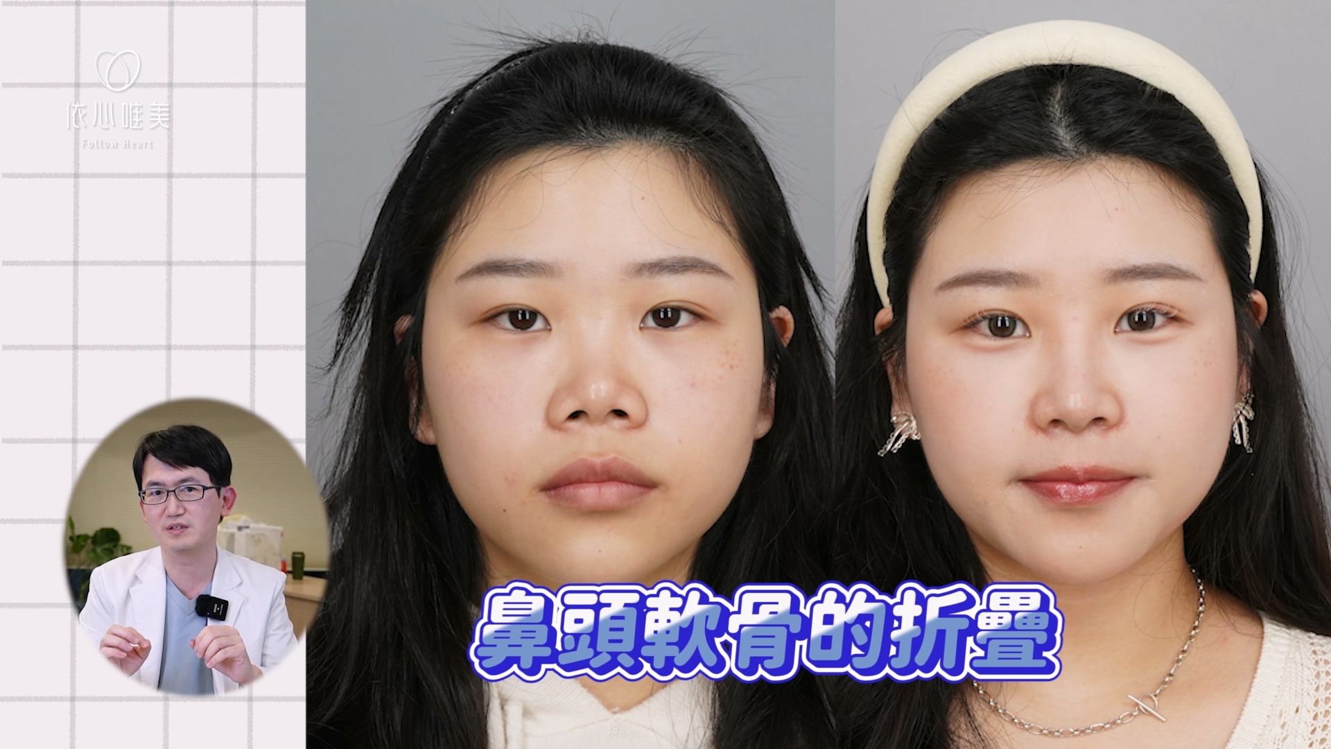 隆鼻+鼻頭軟骨折疊，可改善30%露鼻孔