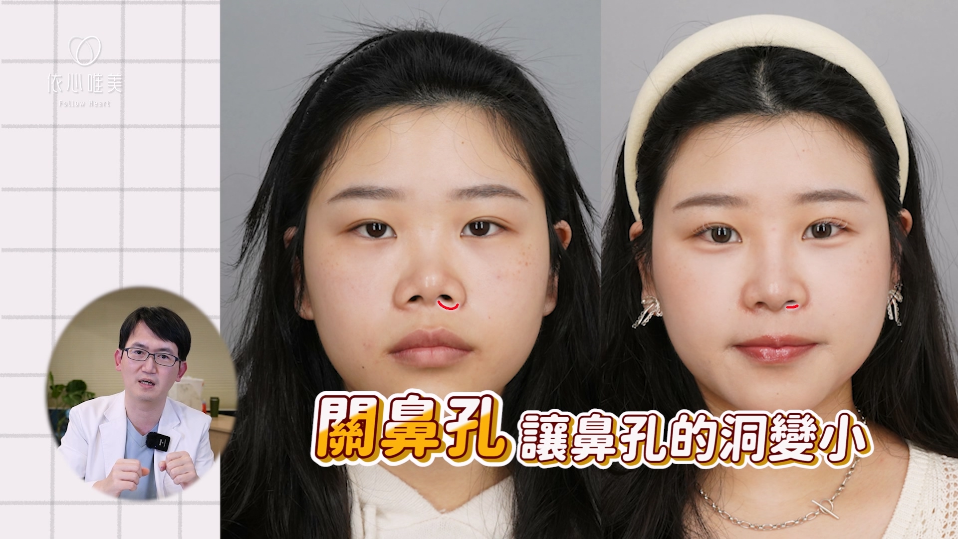 內外上縮鼻翼，把鼻孔洞變小，約可再改善30%露鼻孔