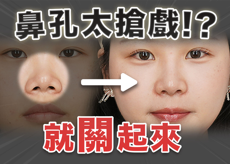 露鼻孔怎麼改善？隆鼻只延長鼻頭還不夠，謝東穎醫師分析鼻翼與鼻孔地板是關鍵