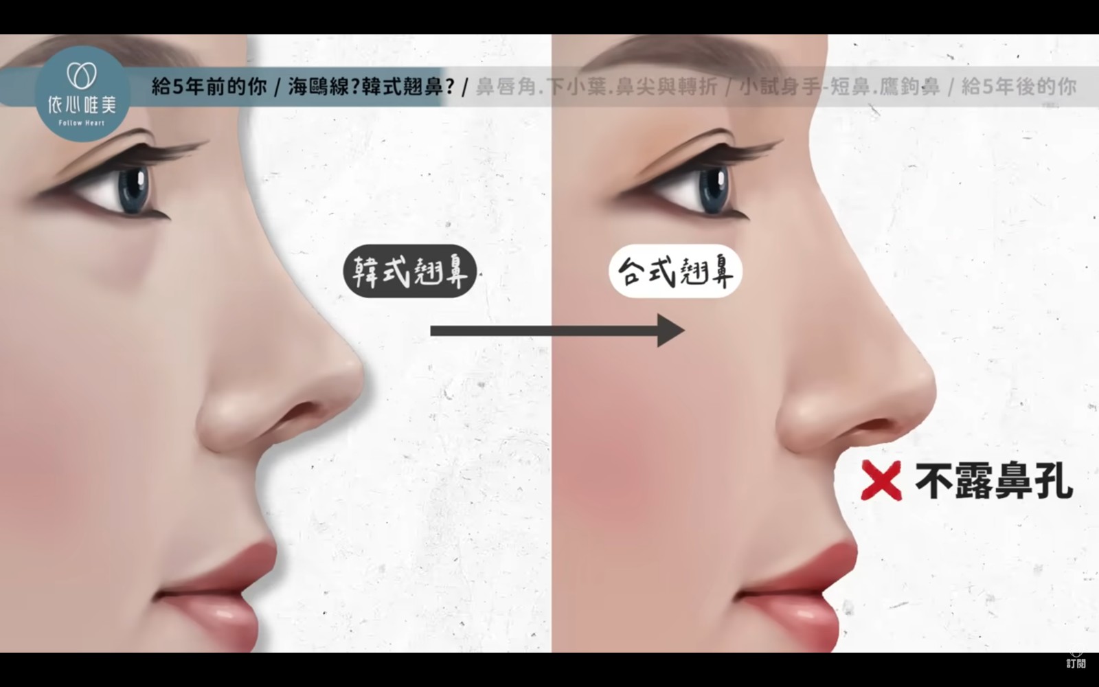 側面能看見柔和的小翹弧度，正面則不會因為追求翹度而過度暴露鼻孔。