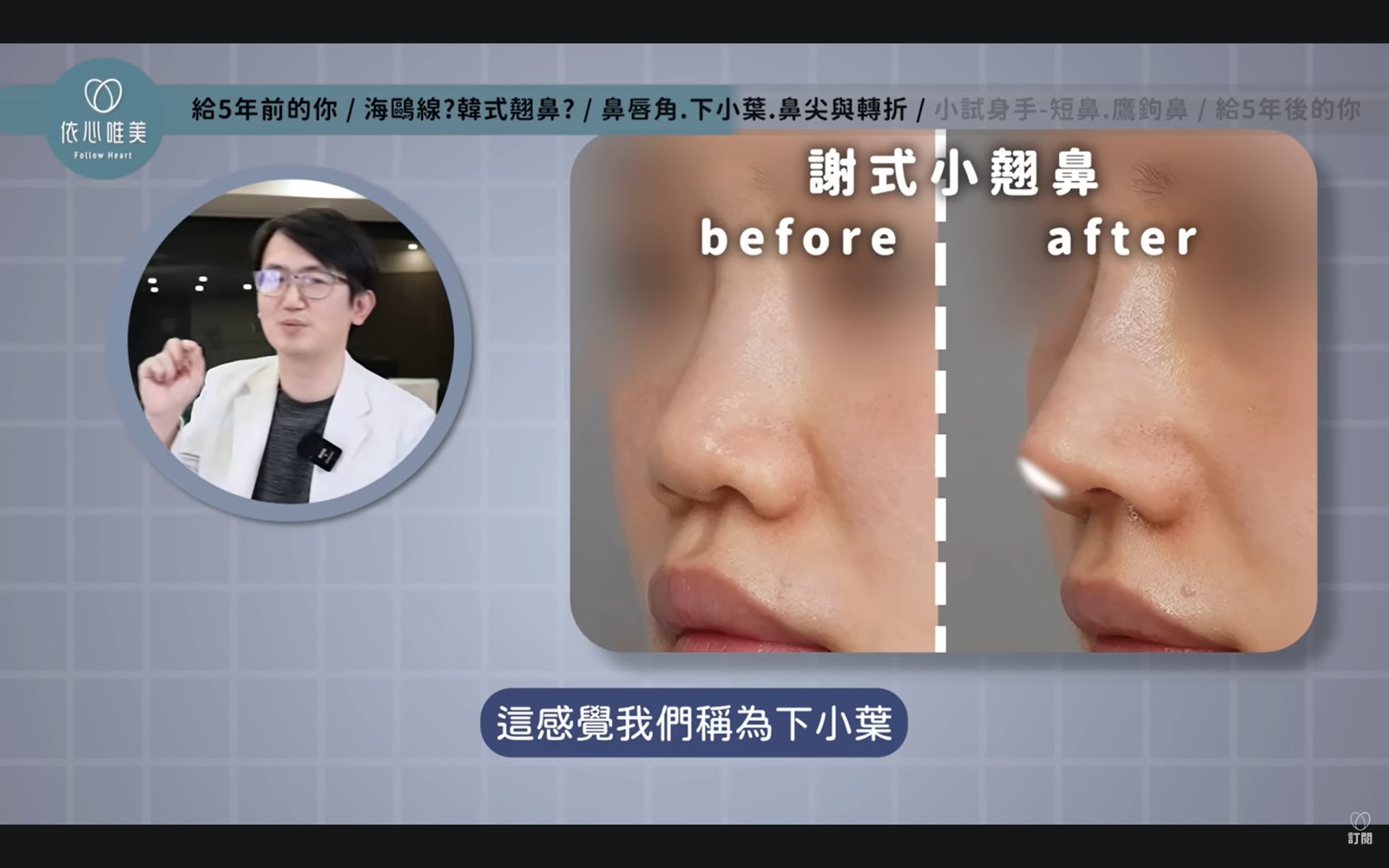 鼻尖下方與鼻小柱銜接的區域稱為「下小葉」，它同樣會影響鼻子的氣質。