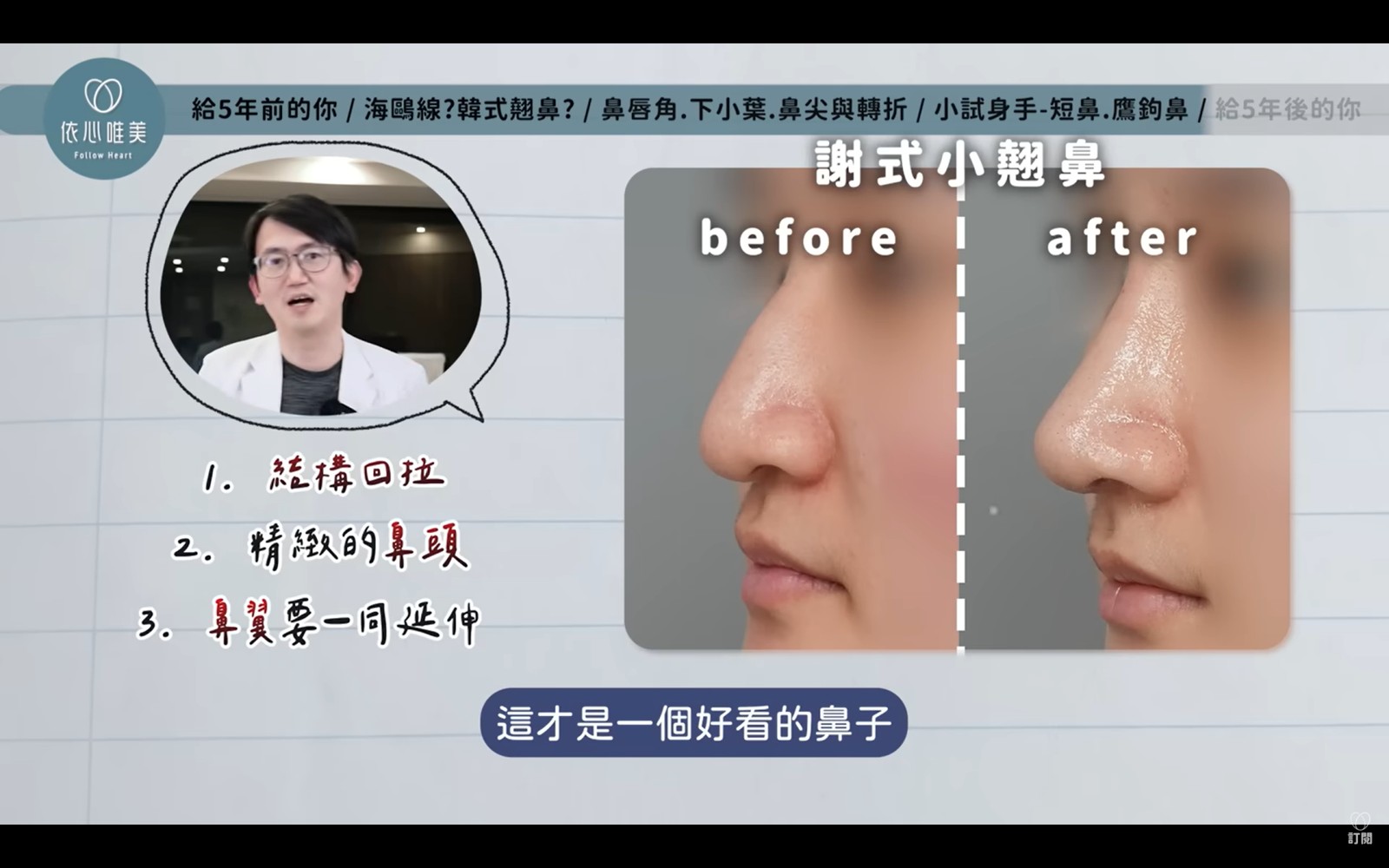 鷹鉤或巫婆鼻，要先把整個鼻頭結構往上回拉，再確認鼻翼邊緣是否足夠下壓，導致露鼻孔。