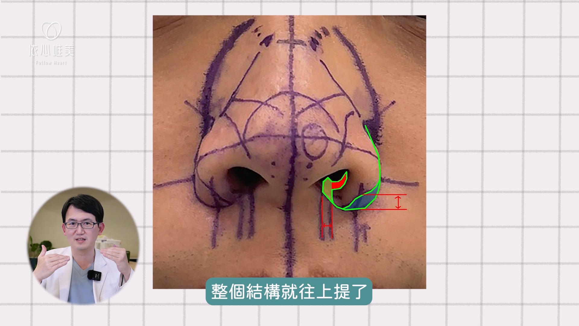 上縮鼻翼:修除紅色三角，最後縫合後將整體結構往上提